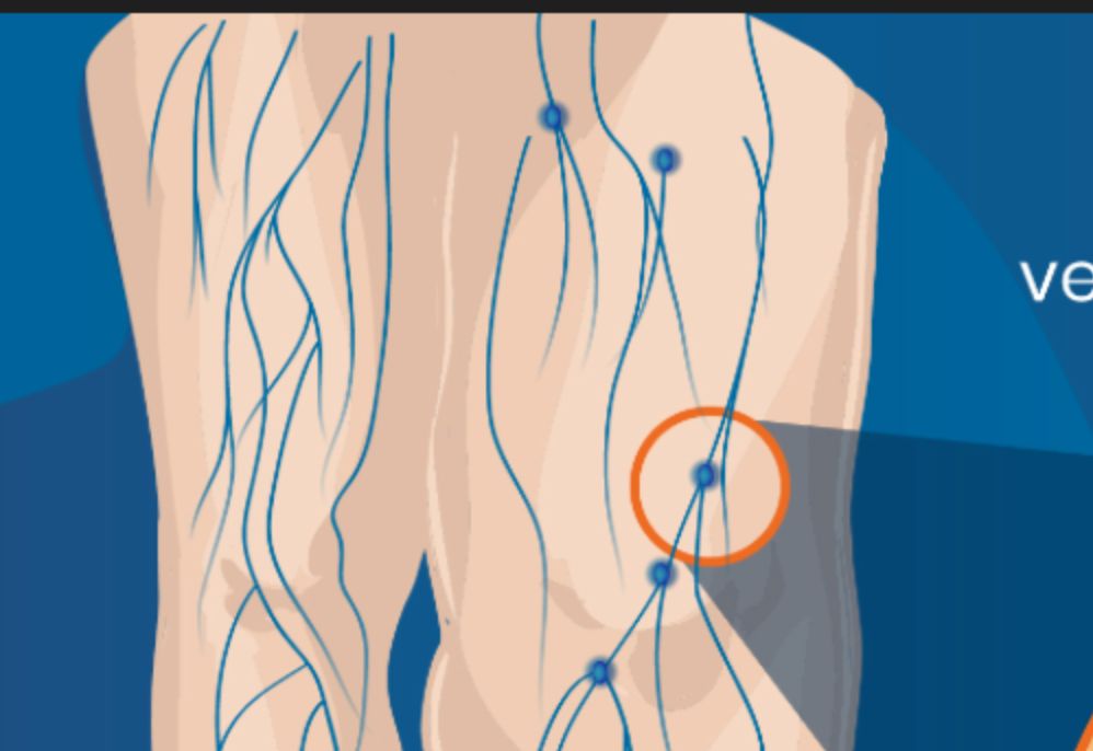 Anatomical illustration of lymphatic vessels across the back and side of the torso, with one area circled.
